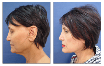 Best Facelift Surgeon