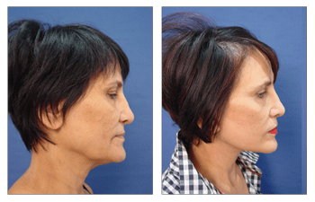 Best Facelift Surgeon