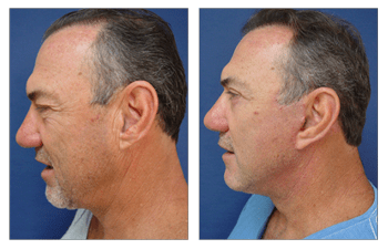 Before and after image of a patient after a proper facelift preparation