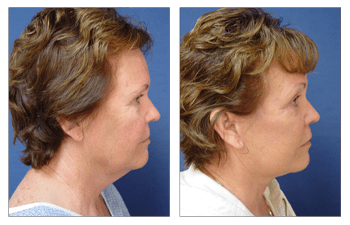 Before and After surgery photo performed by a top facelift surgeon