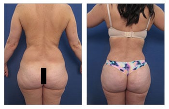 Buttock enhancement : Buttock Dr Ballieux, plastic surgery specialist