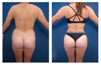 Enhance Your Contours with Butt Implants