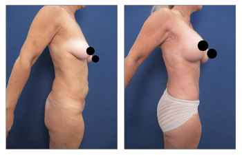 How to fix breast Herniation