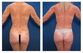 Body Contouring corrects specific areas of body concern