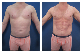 Abdominal Etching 2- Replace the left upper quadrant