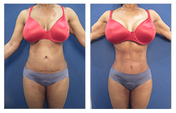 Female before and after abdominal etching procedure to replace the right lower quadrant - front view