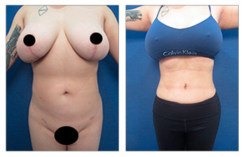 Flanks Lipo - High Definition Flank Liposuction