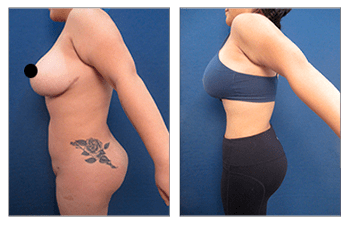 Los Angeles Liposuction Centers on X: Female patient is one year post op  from Smartlipo of her upper back and bra fat. Her results? A leaner,  curvier and more defined back. Who