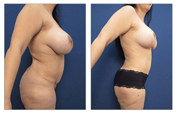 Breast Rejuvenation Options After Pregnancy and Breastfeeding