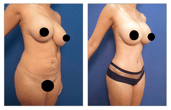 Avoid dog ears following tummy tuck before and after