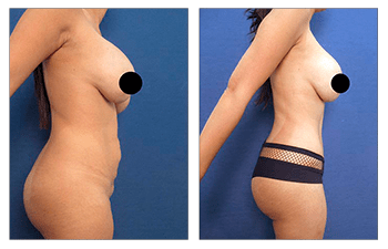 Avoid dog ears following tummy tuck before and after