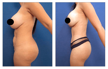 Avoid dog ears following tummy tuck before and after