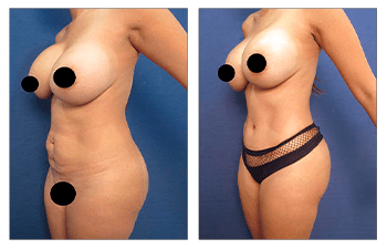 Avoid dog ears following tummy tuck before and after