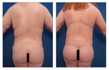 Buttock Enhancement Surgery  Newport Beach & Orange County