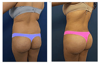 butt-augmentation-1-Replacement