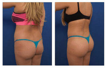 butt-augmentation-2-Replacement