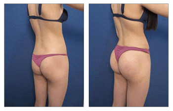 butt-augmentation-9-Replace butt aug6