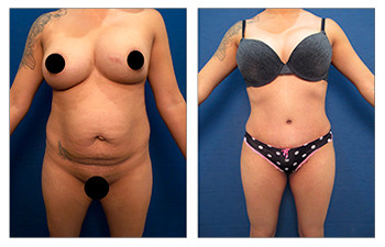 Ideal Belly Button Shape With Tummy Tuck