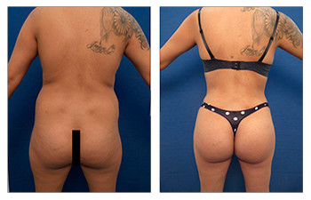 Combining tummy tuck with Lipo 360 rear view