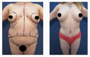 Case Study: Tummy Tuck for the Double Roll Abdominal Deformity - Explore  Plastic Surgery