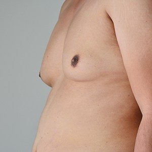 387915 MowlaviBodySq 7 031119 gynecomastia