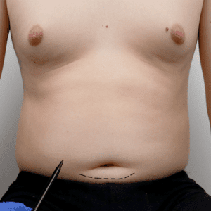 gynecomastia patient